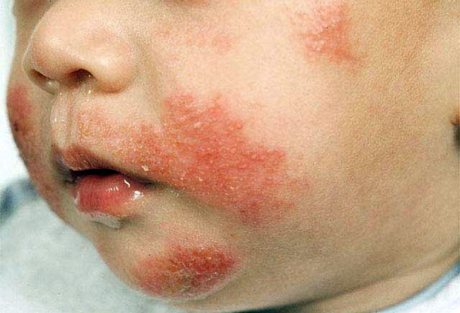 Alergi Susu Umumnya Dialami oleh Anak-anak